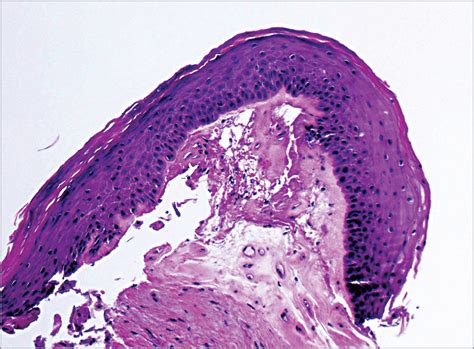 lichen sclerosus genitalis|lichen sclerosus et atrophicus vaginal.